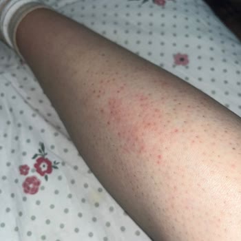 Selin Beauty Center Güzellik Merkezi Seans Sonrası Laser Yanığı