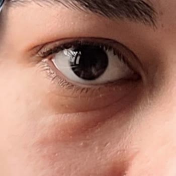 Maruderm Yüz Yıkama Jeli Alerji Yaptı, Cildim Ve Gözlerim Mahvoldu!