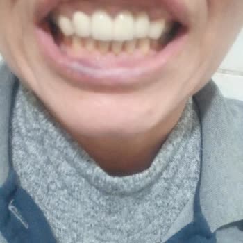 Alsancak Ağız Ve Diş Sağlığı Merkezi (İzmir) Yaptığı Yamuk Metal Diş Protez