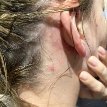 Solgar Calcium Magnesium Plus Zinc Alerji Şikayeti