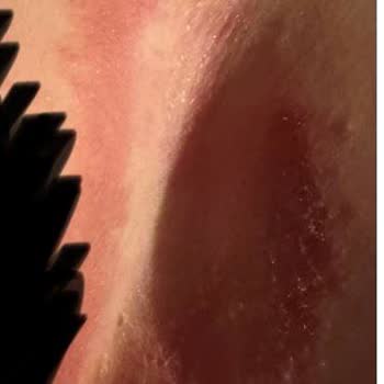 Sleepy Natural Cilt Yanığına Neden Oldu