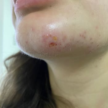 Neslihan Kişisel Bakımevi İsimli Güzellik Salonunda Yüzüm Yandı