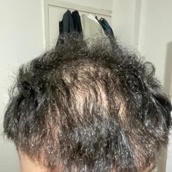 Need Clinic Başarısız Saç Ekimi