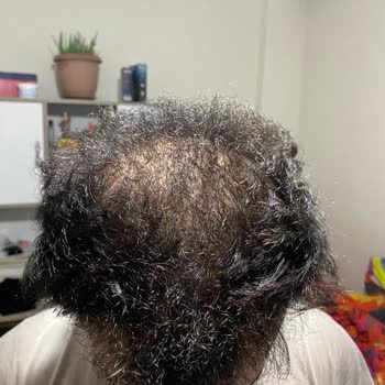 Need Clinic Başarısız Saç Ekimi