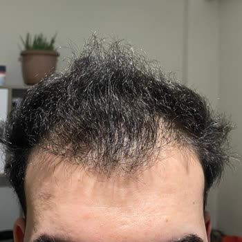 Need Clinic Başarısız Saç Ekimi