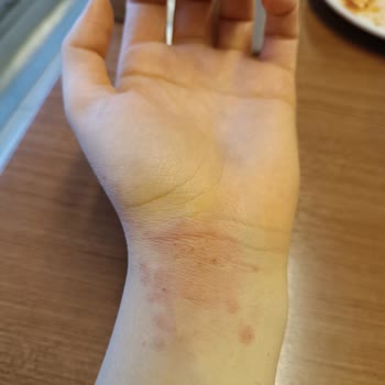 Bilim İlaç Klomaks Antibiyotik Alerjisi