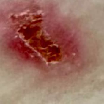 Blue Life Beauty Kalitesiz Çatlak Tedavisi Deneyimim