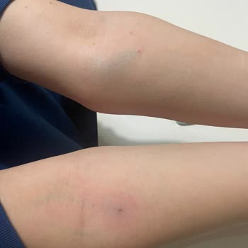 Özel Bilgi Hastanesi (Ankara) Bilgi Hastanesi Personeli Şikayeti