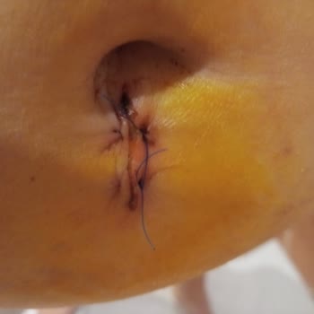 Fatih Sultan Mehmet Eğitim Ve Araştırma Hastanesi Hayatımda Böyle Dikiş Görmedim! 😡