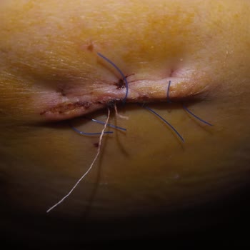 Fatih Sultan Mehmet Eğitim Ve Araştırma Hastanesi Hayatımda Böyle Dikiş Görmedim! 😡