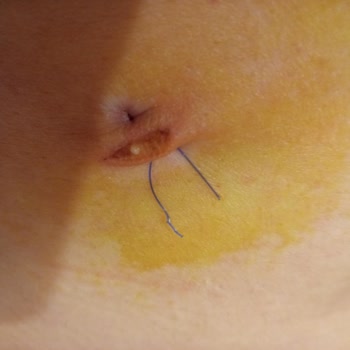 Fatih Sultan Mehmet Eğitim Ve Araştırma Hastanesi Hayatımda Böyle Dikiş Görmedim! 😡