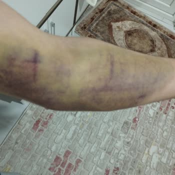 Türk Kızılay'ın Aldığı Kan Sonucu