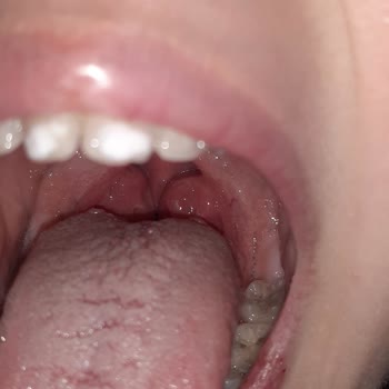 Aile Sağlığı Merkezleri Bademcik İltihabına Bile Antibiyotik Yazmayan Doktor