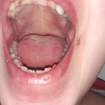 Aile Sağlığı Merkezleri Bademcik İltihabına Bile Antibiyotik Yazmayan Doktor