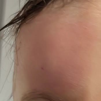 Mustela Arnica Jeli Şişlik Yerine Kızarıklığa Yol Açtı!