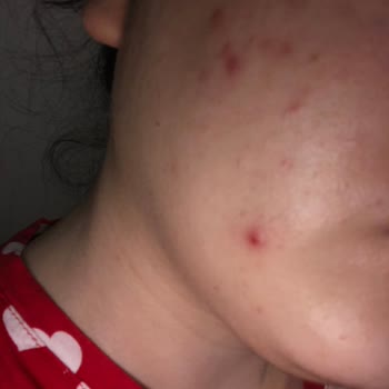 Vermehrter Haarwuchs und Pickel nach Anwendung von La Roche Posay Effaclar Duo