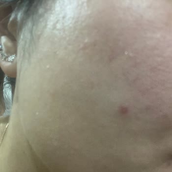 Hautreizungen und Pickelausbruch nach La Roche-Posay Anthelios Uvmune400 50+