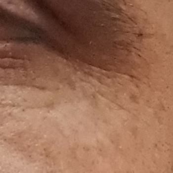 Eslamer Lazer'in&nbsp; Lazer Epilasyonda Yüz Yakması