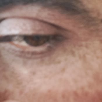 Eslamer Lazer'in&nbsp; Lazer Epilasyonda Yüz Yakması