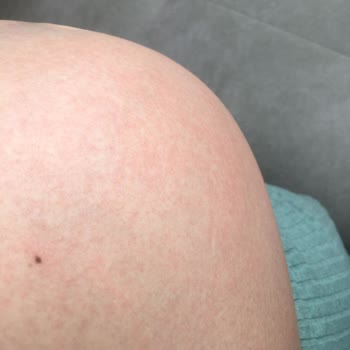 Dalin Bebe Yağı Alerji Yaptı