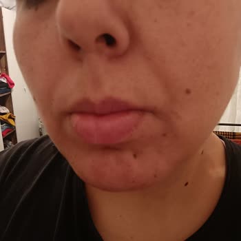 S'he Vec. Ürünler Yüzümde Yanma Sivilceler Yaptı