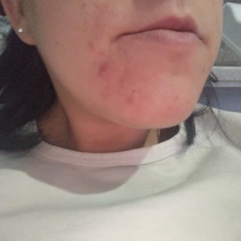 The Purest Solutions Cilt Bakım Ürünü Tepkisi: Beklenmedik Sivilce Sorunu