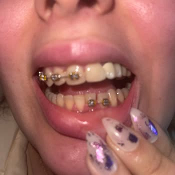 Safir Sağlık Tıp Merkezi Diş Doktoru Dişlerimi Mahvetti