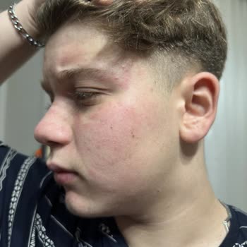 Yves Rocher Yüz Temizleme Jeli Yüzümü Yakıp Tahriş Etti