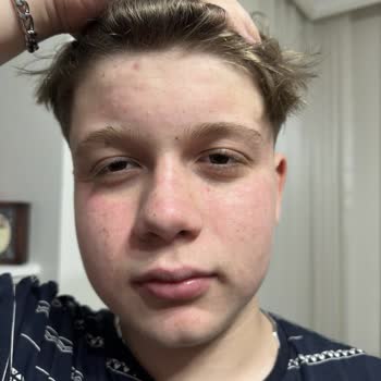 Yves Rocher Yüz Temizleme Jeli Yüzümü Yakıp Tahriş Etti