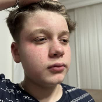 Yves Rocher Yüz Temizleme Jeli Yüzümü Yakıp Tahriş Etti