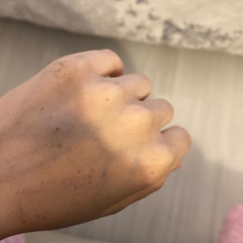 Yaşam Hastanesi (Batman) Damar Yolu Şikayeti