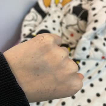 Yaşam Hastanesi (Batman) Damar Yolu Şikayeti