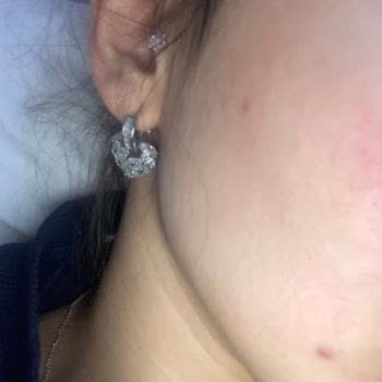 Missha Güneş Kremi Kullanımı Sonrası Ciltte İzlerin Oluşması