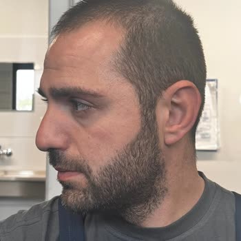 Unhappy With Estetik International Hair Transplant