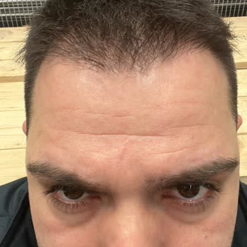 Unhappy With Estetik International Hair Transplant