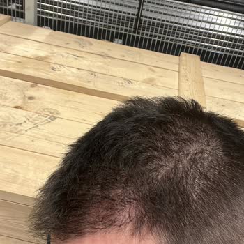 Unhappy With Estetik International Hair Transplant