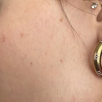 Nish Estetik Q Switch Lazer