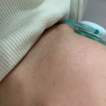 Mustela Yenidoğan Şampuanı Cilt Kuruluğu Ve Alerji Yaptı