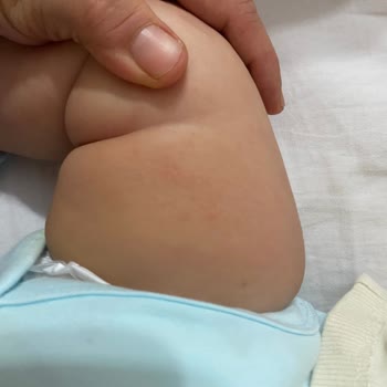 Mustela Yenidoğan Şampuanı Cilt Kuruluğu Ve Alerji Yaptı
