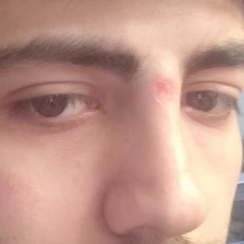 Rana Alver Beauty 2 Derece Yanık