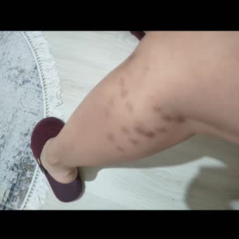 Estemed Lazer Estetik Tekirdağ'daki Lazer Kliniğinde Yaşanan Mağduriyet