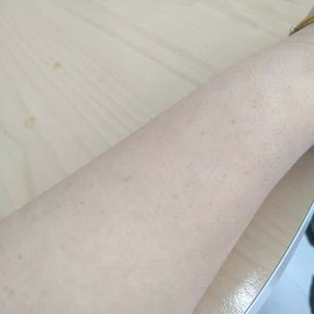 Dilan Polat Estetik Malatya'da Lazer Epilasyon Mağduriyeti