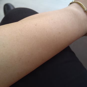 Dilan Polat Estetik Malatya'da Lazer Epilasyon Mağduriyeti