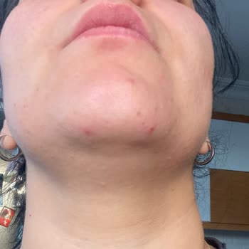 Yves Rocher Ürünleri Cildimde Sivilce Yanma Ve Kalıntı Yaptı