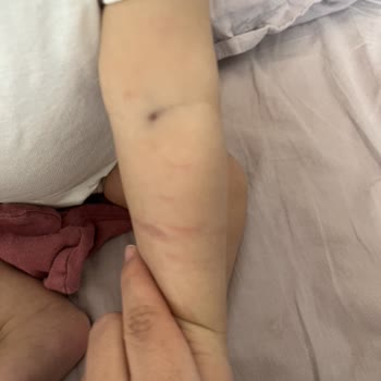 Ankara Medicana/ Bebek Hemşiresi Bebeğimin Kolunu Morarttı