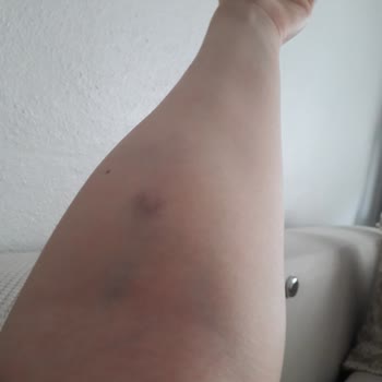 Özel Aritmi Osmangazi Hastanesi Acil Hemşiresinin İş Bilmezliği!