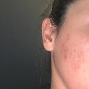 La Roche - Posay Effaclar Duo Kullanımı Sonrası Cilt Problemleri