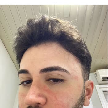 La Roche - Posay Yüzümü Yakması