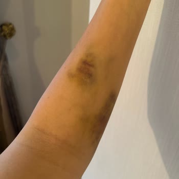 Beytepe Murat Erdi Eker Devlet Hastanesi Kan Tahlil Sonrası Hala Devam Olan Kol Morluk Ve Kol Ağrısı