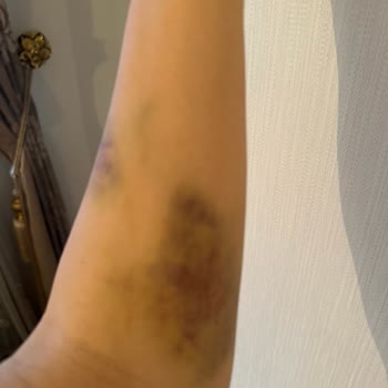 Beytepe Murat Erdi Eker Devlet Hastanesi Kan Tahlil Sonrası Hala Devam Olan Kol Morluk Ve Kol Ağrısı